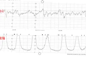 五步带您学会看胎心监护报告图片