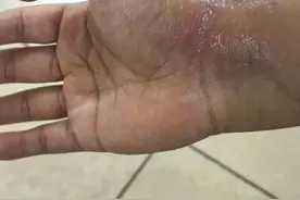 太毒！被它咬一口，福建女子手掌又疼又肿！这种细菌感染很要命图片