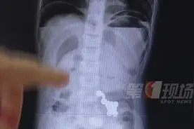 5岁娃吞了20多颗，消化道穿孔！家长：都是哥哥以前的玩具……图片