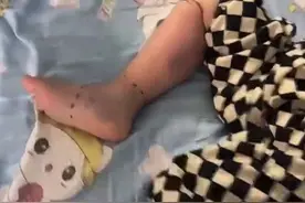 镇江人当心，2岁男童去了趟菜场面临截肢！图片