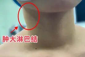 13岁女孩确诊甲状腺癌！警惕脖子上这种“小疙瘩”图片