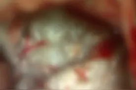 五旬阿姨走路不稳、随时摔跤，一查脑子里长了“珍珠”图片