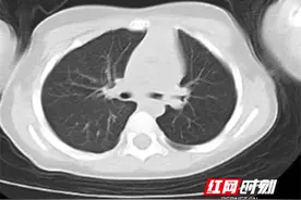 卓越医疗丨2岁幼儿误食瓜子被呛 永州市中心医院成功救治图片