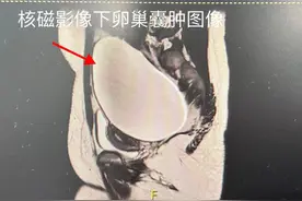 肚脐眼里巧剥囊肿无痕摘除，13岁女孩肚里取出2.5公斤“木瓜”图片