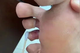 科普动起来｜降雨持续！警惕雨后的这4类皮肤病图片