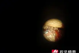 老人眼睛瘙痒难耐竟是虱虫寄生眼睑，孙女也感染了！医生提醒图片