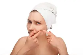 忍不住挤痘痘，可以这样做图片