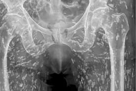 美国一男子吃了没熟的猪肉，下半身遍布绦虫卵图片