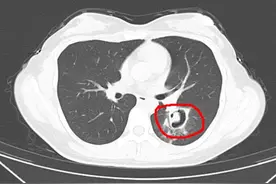 女子清理发霉衣柜后高烧到40℃不退，一查竟是肺部“发霉”了！图片