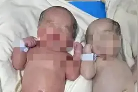 双胞胎在子宫内斗争出生后一红一白 “白宝宝”血液“抢走”图片