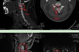 脖子疼误以为是落枕，青年女子患上罕见病！康复大学青岛中心医院多学科协作让其痊愈出院图片