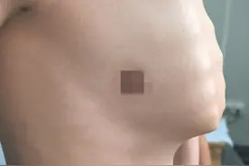 15岁少年严重自卑，竟是因为这种常被忽视的畸形图片