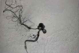 19岁女孩颅内长“蛇形动脉瘤”，协和专家联手“掐断”病灶血供图片