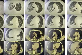 心衰导致的胸腔积液需要抽液吗？图片