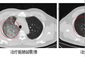 确诊1例！反复发烧，不一定是阳了图片