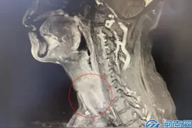 泉州：6旬大叔多病缠身 又查出下咽癌图片