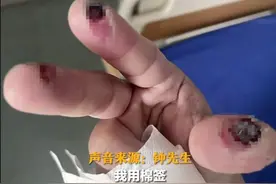 不小心碰了下，男子三根手指烂出黑洞！紧急提醒！图片
