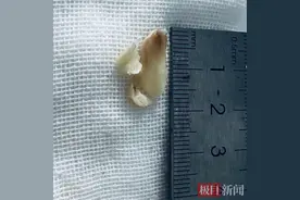 锋利鱼骨卡在婆婆的支气管，医生这样操作帮她取出异物图片