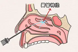 过敏性鼻炎还能做手术？重庆松山医院：需医生严格评估图片
