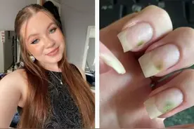 由于频繁做美甲 女子指甲上长出绿色霉菌图片