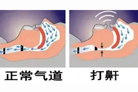 健康你我他｜打呼噜就是睡得香吗？“呼噜事件”需警惕图片