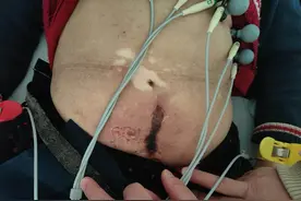 八旬奶奶贴暖宝宝致二度烫伤，进医院还纳闷“不热啊”……医生紧急提醒图片