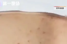 跑步出汗不及时擦干，男子感染真菌！“治疗时被疼哭……”图片