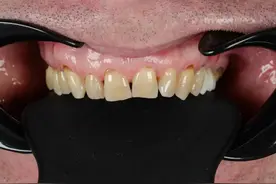 吃饭老塞牙？千万别忽视，可能是牙齿在报警图片