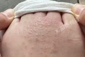 西安一女子商场试鞋后脚部真菌感染，预防足癣你还需要知道这些事！图片