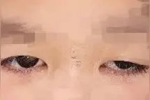 5岁男孩眼睛动了下，瞬间变帅了……医生：孩子这种“大小眼”，家长要留心图片
