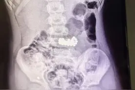 福建女孩在幼儿园“闯大祸”！爸妈吓坏了！医生紧急从胃里取出38颗......图片