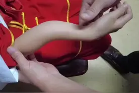 30秒丨10岁女孩摔倒意外骨折 中医正骨瞬间复位！图片