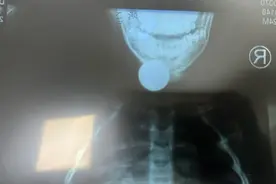2岁幼童硬币卡喉辗转就医，龙岗铁骑一路及时护送图片