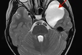 孩子6岁了还不会说话，竟然是脑子里长了这个东西图片
