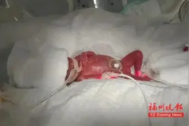出生时不到1斤！“拇指姑娘”出院了！图片