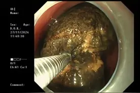 老人吃柿子吃出10厘米胃结石，上海医生胃里碎石避免开腹图片