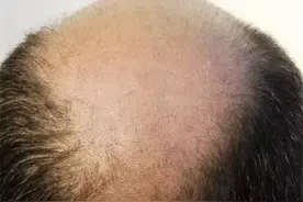 脱发男孩难“脱单” 医生说这几个习惯可以“重建”发量图片