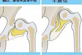 骨科专家为您解析成人先天性髋关节发育不良的症状表现图片