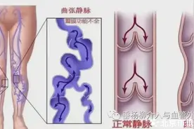 【杨柳科普】腿上爬满“小蚯蚓”？你要知道静脉曲张的4个早期警报！图片