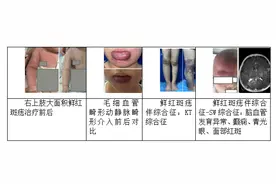 这家医院的鲜红斑痣多学科综合诊疗门诊开诊啦！---为孩子提供“一站式”服务图片
