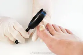 帮你了解脚气、灰指甲、股癣及处理办法图片