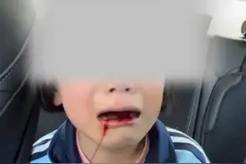 小学一年级女孩被同学打得满口流血，家长“不追究”，法律不可放过图片