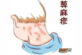 外出露营享受快乐时光 小心这种皮肤病找上你图片