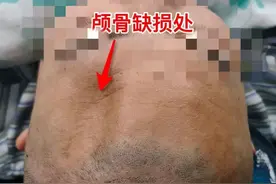 嘉定这家医院用3D打印颅骨，帮患者“重塑肉身”图片