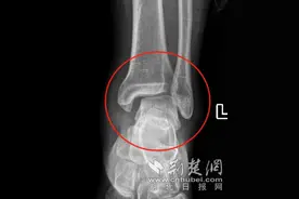 男子“崴脚”后不重视竟险致残 万幸专家及时揪出病灶成功救治图片