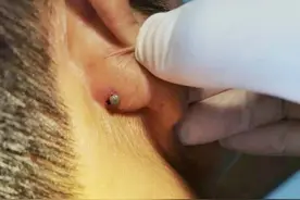 警惕！这个“黑点”又来了，严重可致命！正在高发期图片