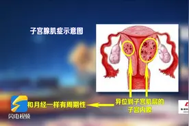 子宫腺肌症为什么会导致不孕？