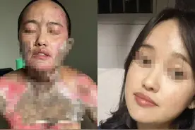 四川凉山一女子称被丈夫泼酒烧伤，三大疑问待解图片