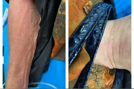 陪家人看病，娭毑突发严重过敏瘫倒！湘雅医院麻醉医生紧急救助图片