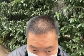 “还能反光！”长沙男子植发近9月称后脑勺“像狗啃过”，机构：满1年才能看到效果图片